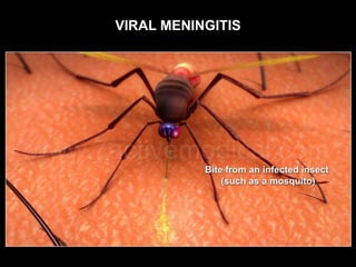 VIRAL MENINGITIS
 