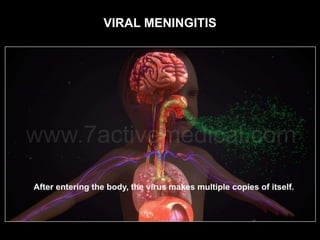 VIRAL MENINGITIS
 