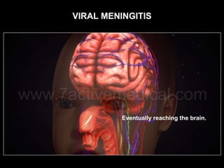 VIRAL MENINGITIS
 