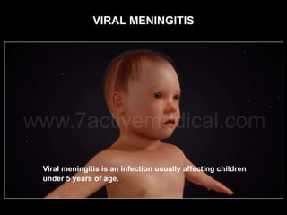 VIRAL MENINGITIS
 