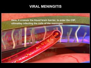 VIRAL MENINGITIS
 
