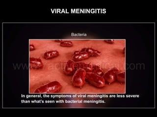 VIRAL MENINGITIS
 