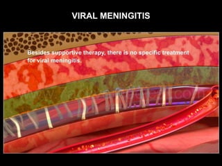 VIRAL MENINGITIS
 