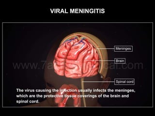 VIRAL MENINGITIS
 