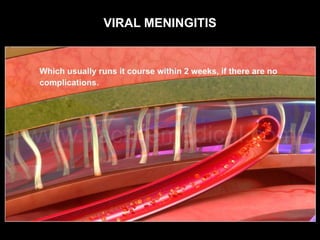 VIRAL MENINGITIS
 