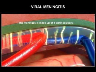 VIRAL MENINGITIS
 