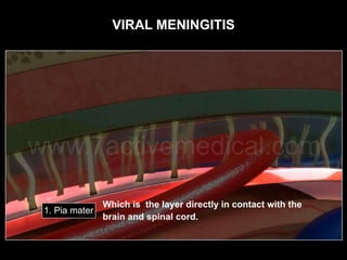 VIRAL MENINGITIS
 