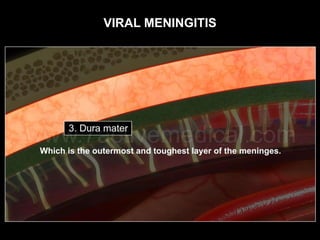 VIRAL MENINGITIS
 