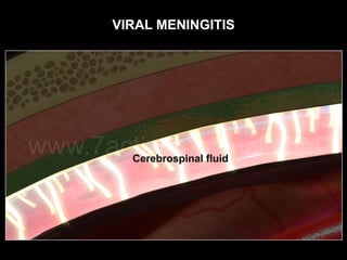VIRAL MENINGITIS
 