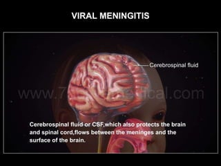 VIRAL MENINGITIS
 