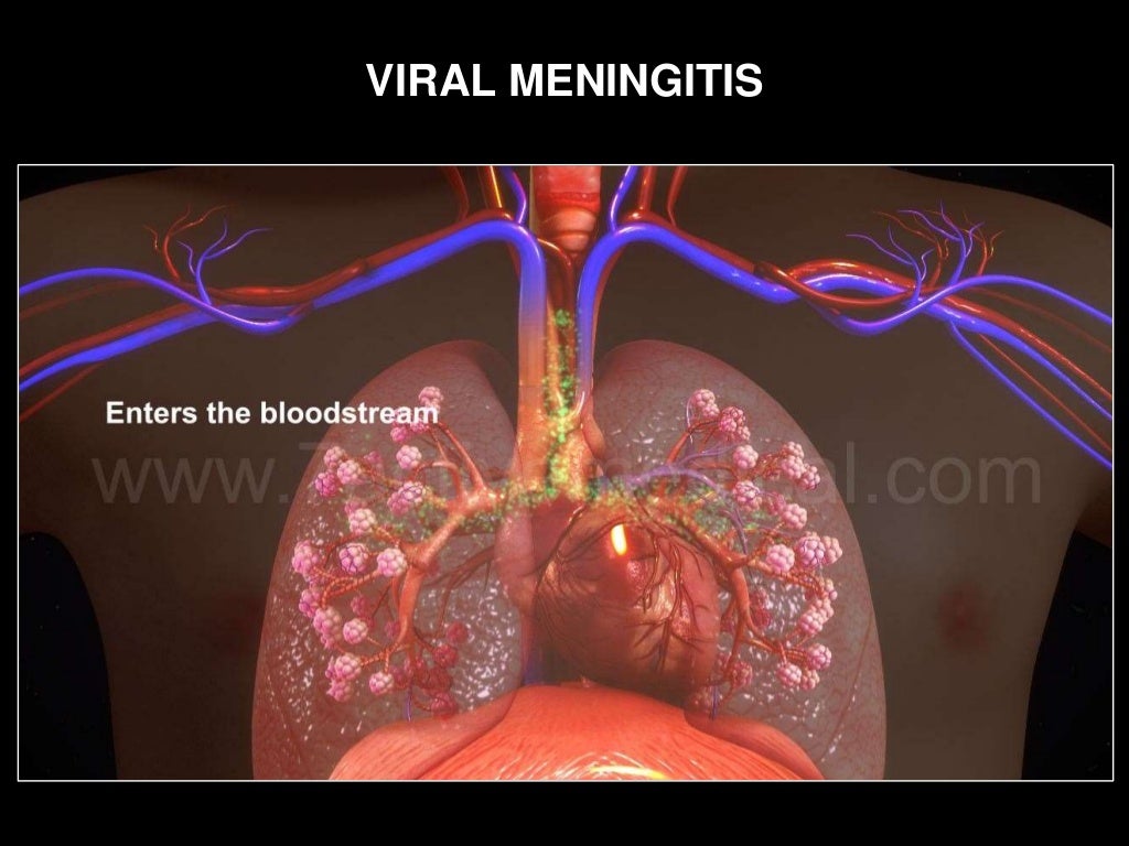 Viral meningitis