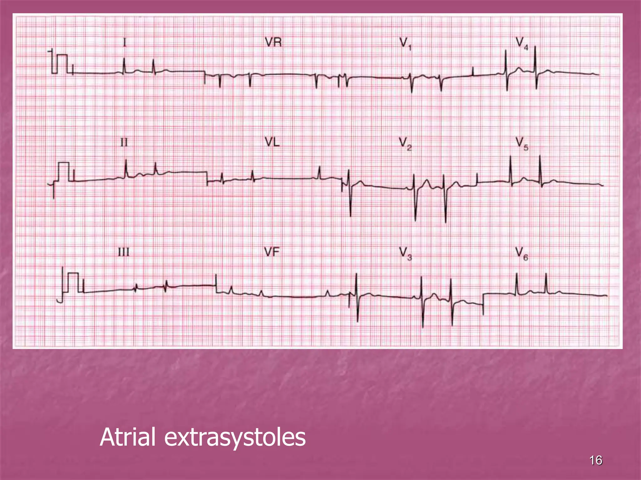 16
Atrial extrasystoles
 