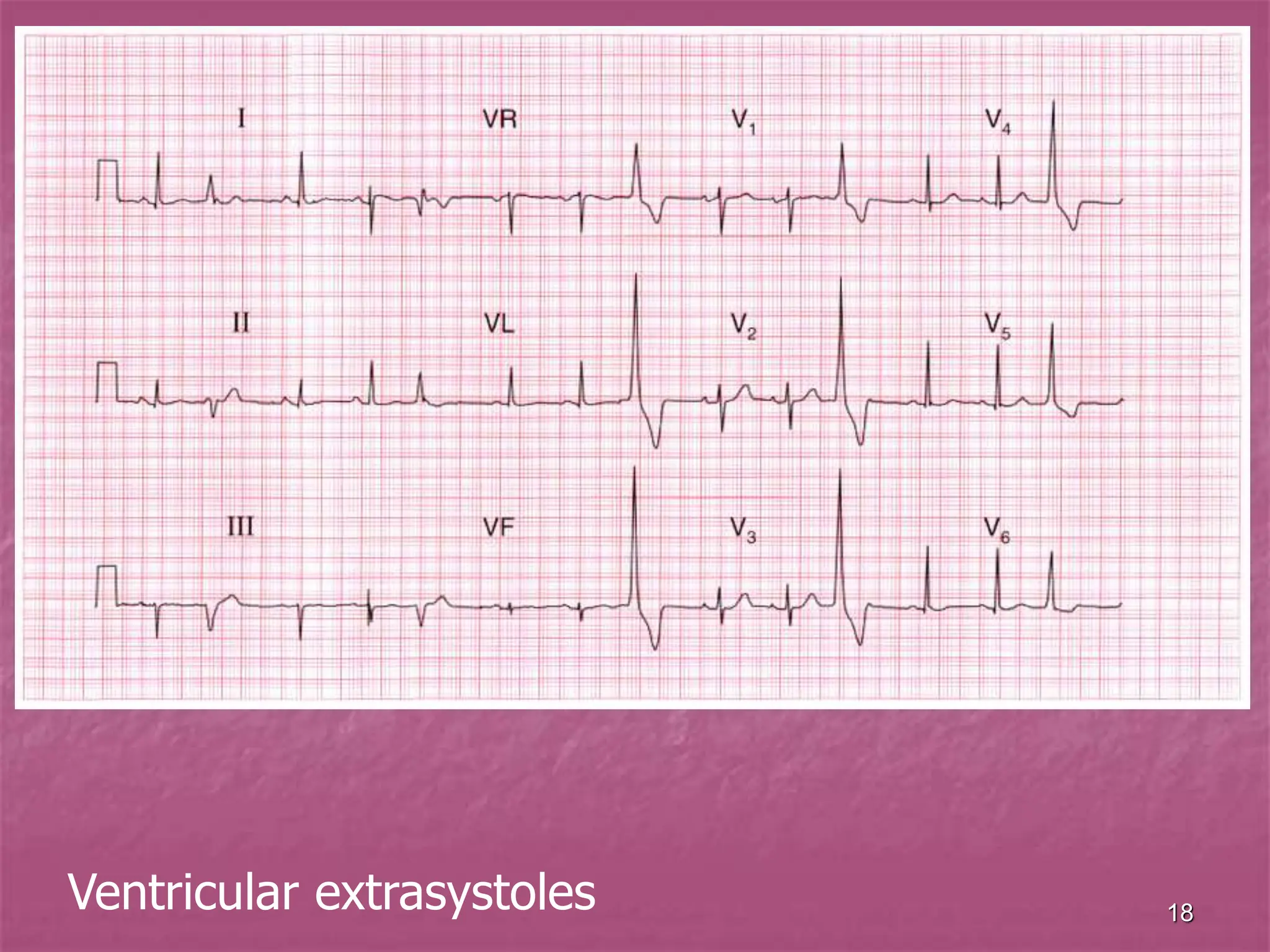 18
Ventricular extrasystoles
 