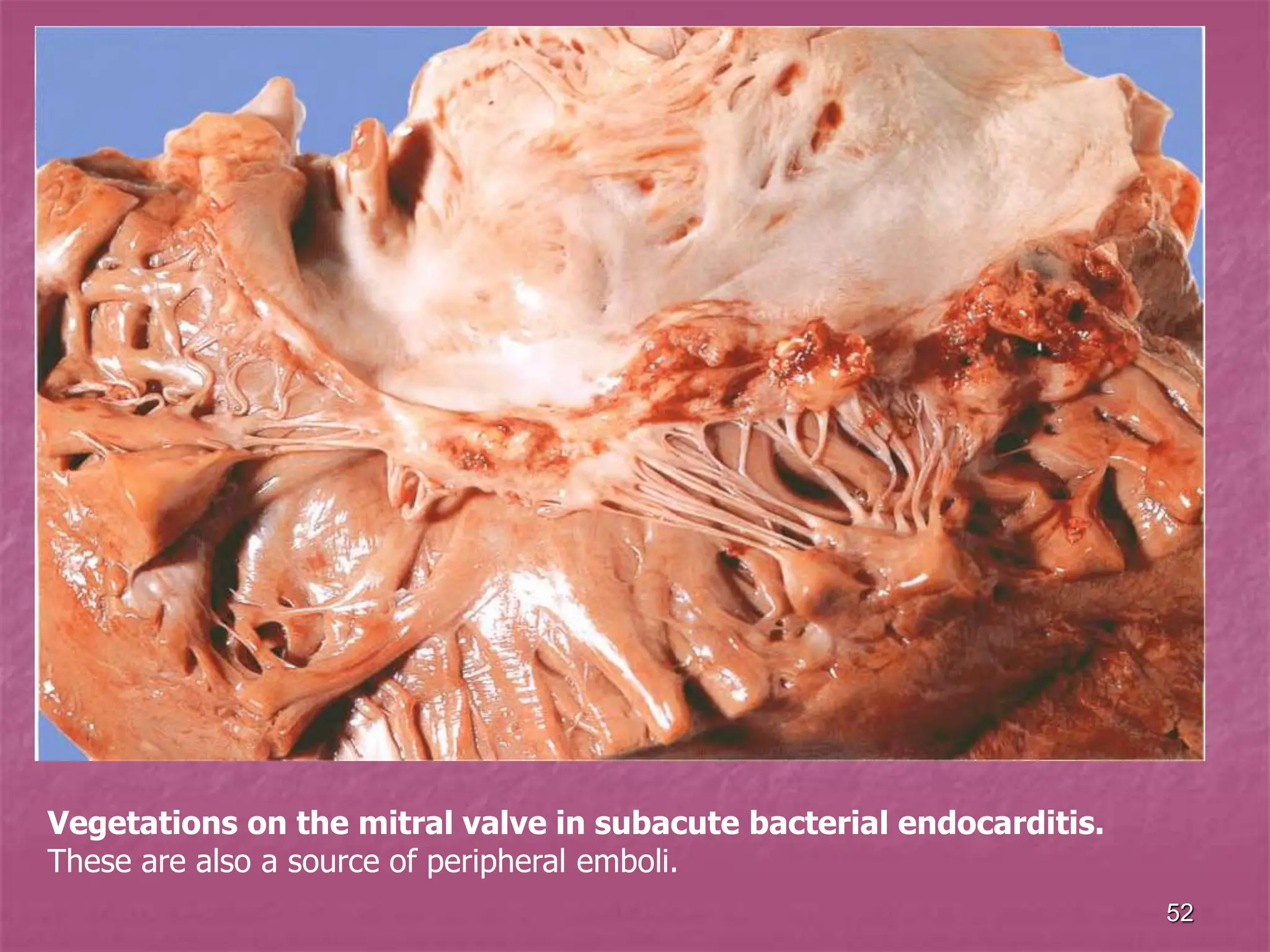 52
Vegetations on the mitral valve in subacute bacterial endocarditis.
These are also a source of peripheral emboli.
 