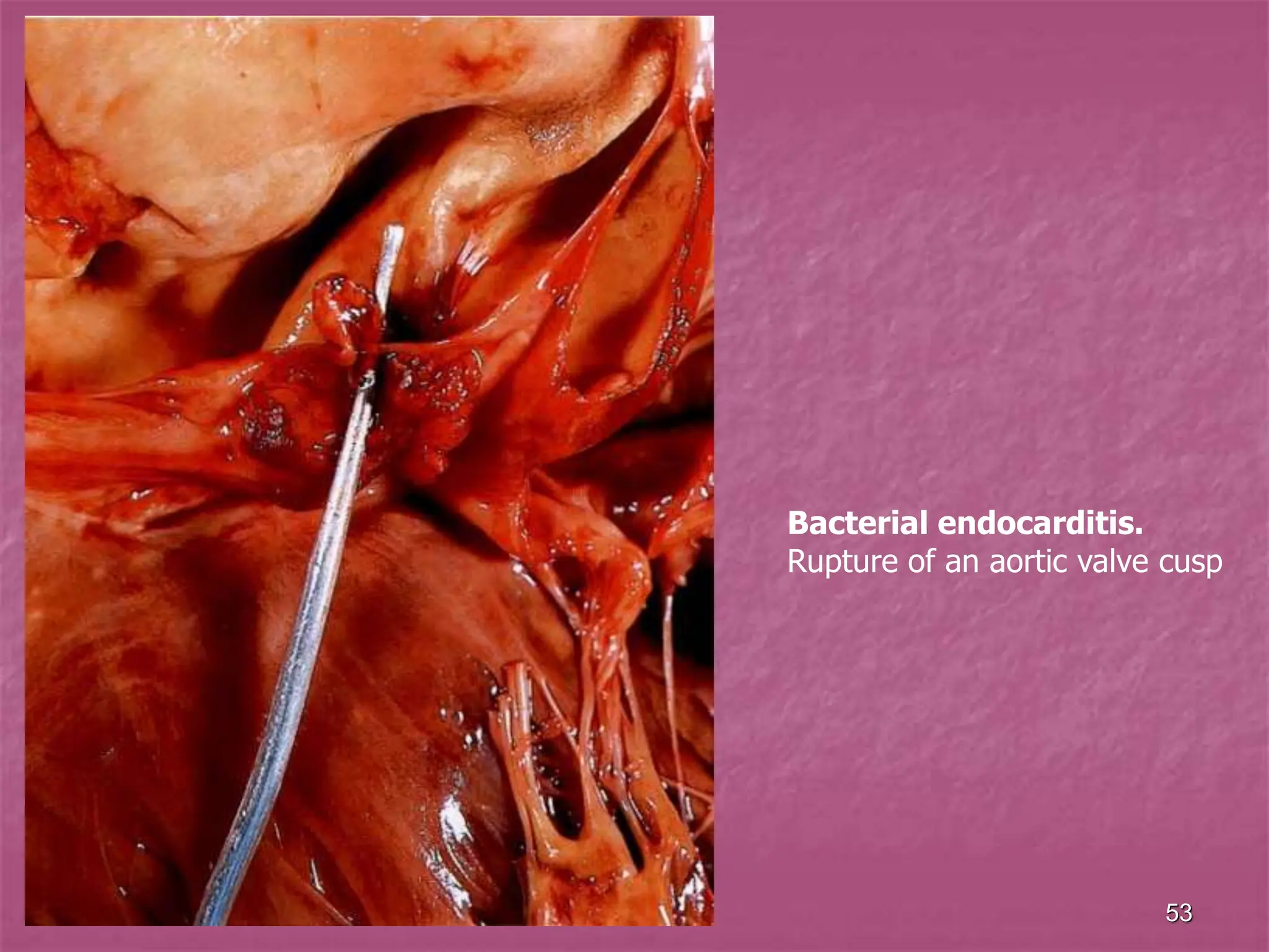53
Bacterial endocarditis.
Rupture of an aortic valve cusp
 