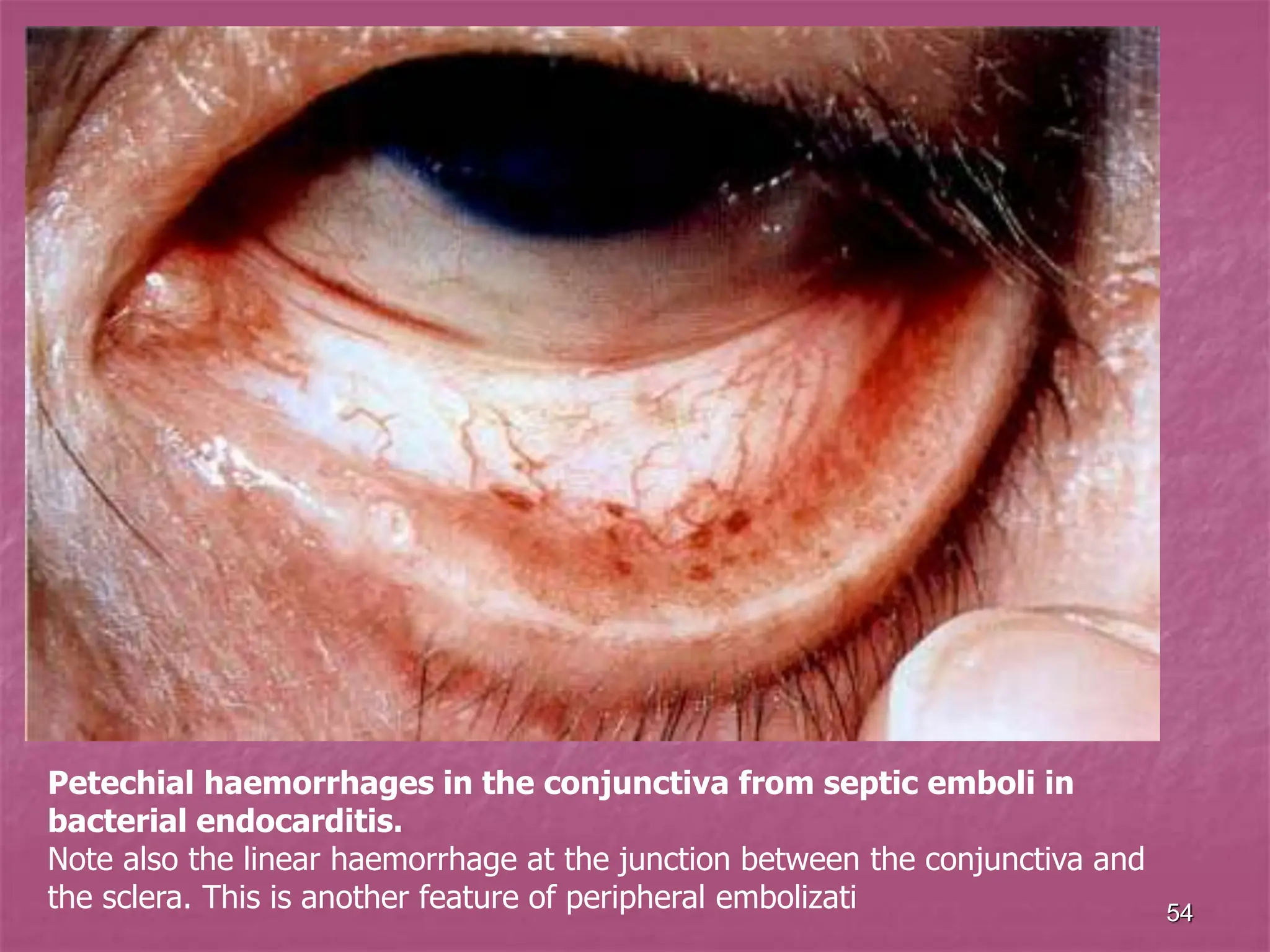 54
Petechial haemorrhages in the conjunctiva from septic emboli in
bacterial endocarditis.
Note also the linear haemorrhage at the junction between the conjunctiva and
the sclera. This is another feature of peripheral embolizati
 