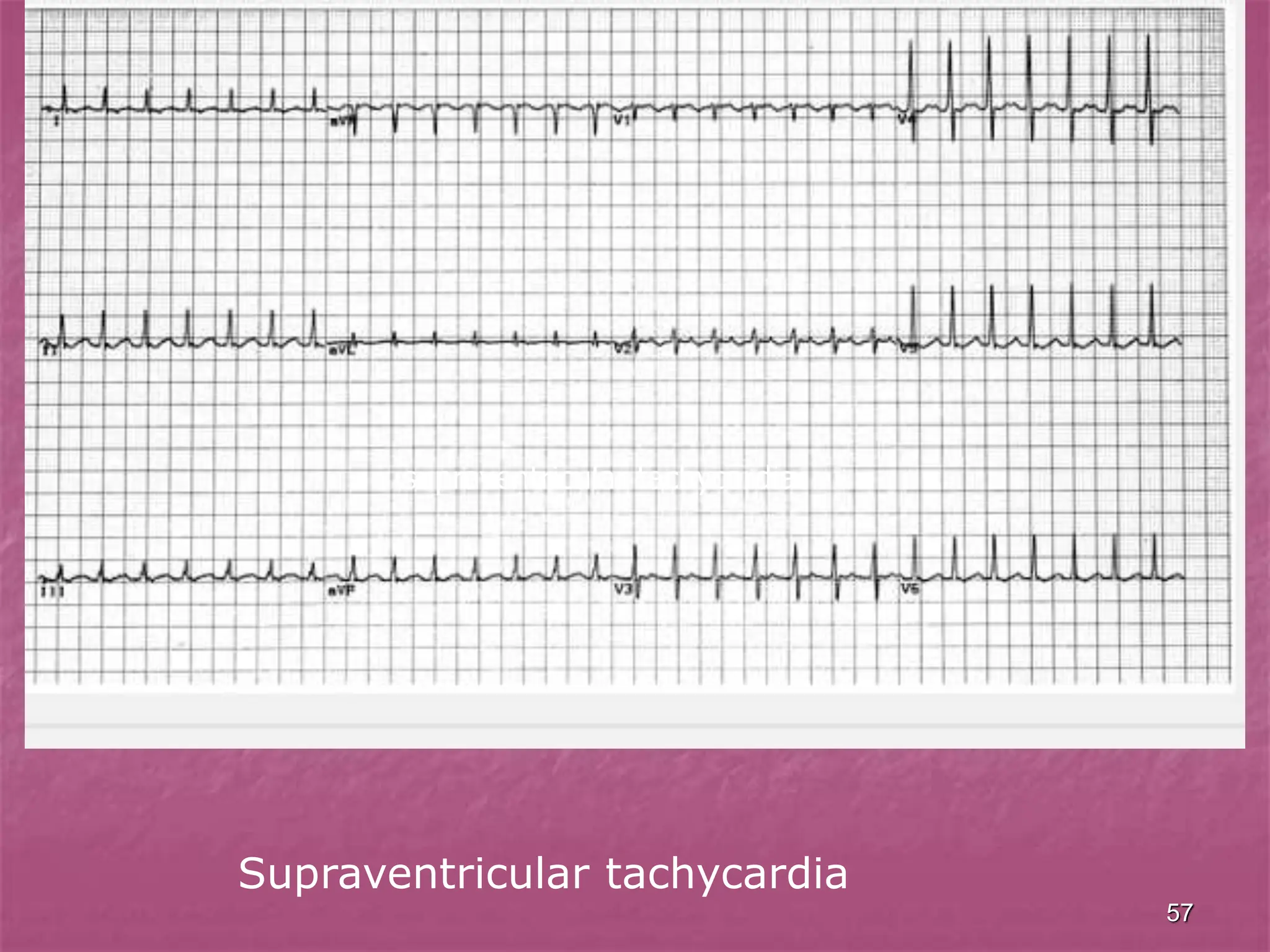 57
supraventricular tachycardia
Supraventricular tachycardia
 