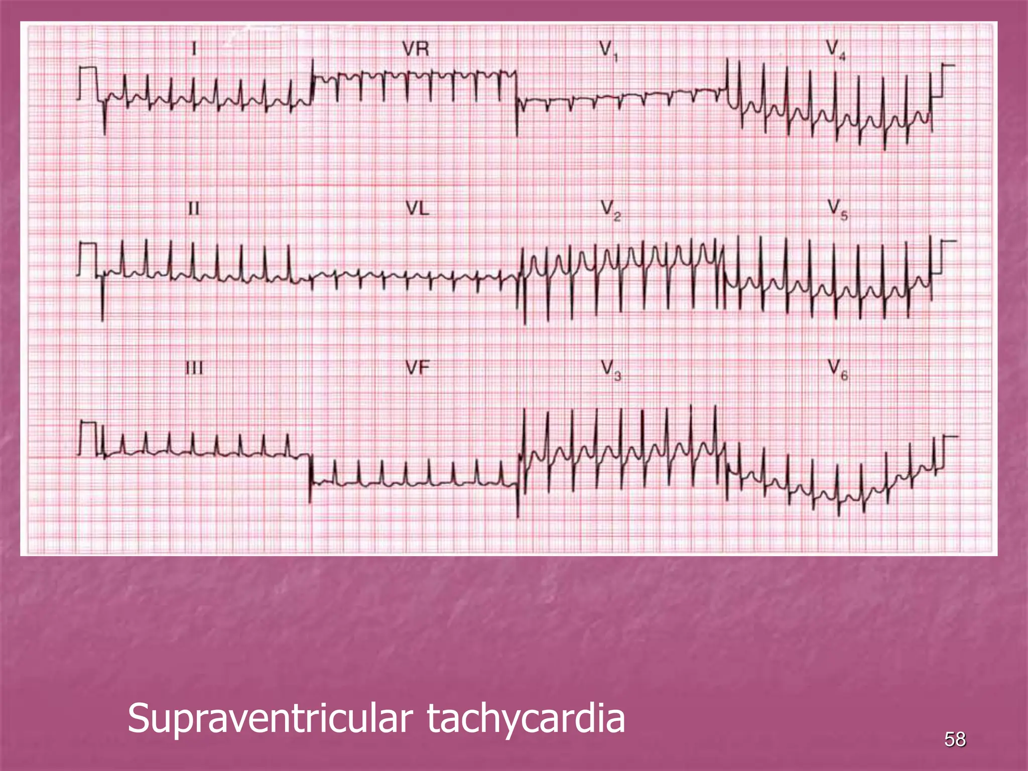 58
Supraventricular tachycardia
 