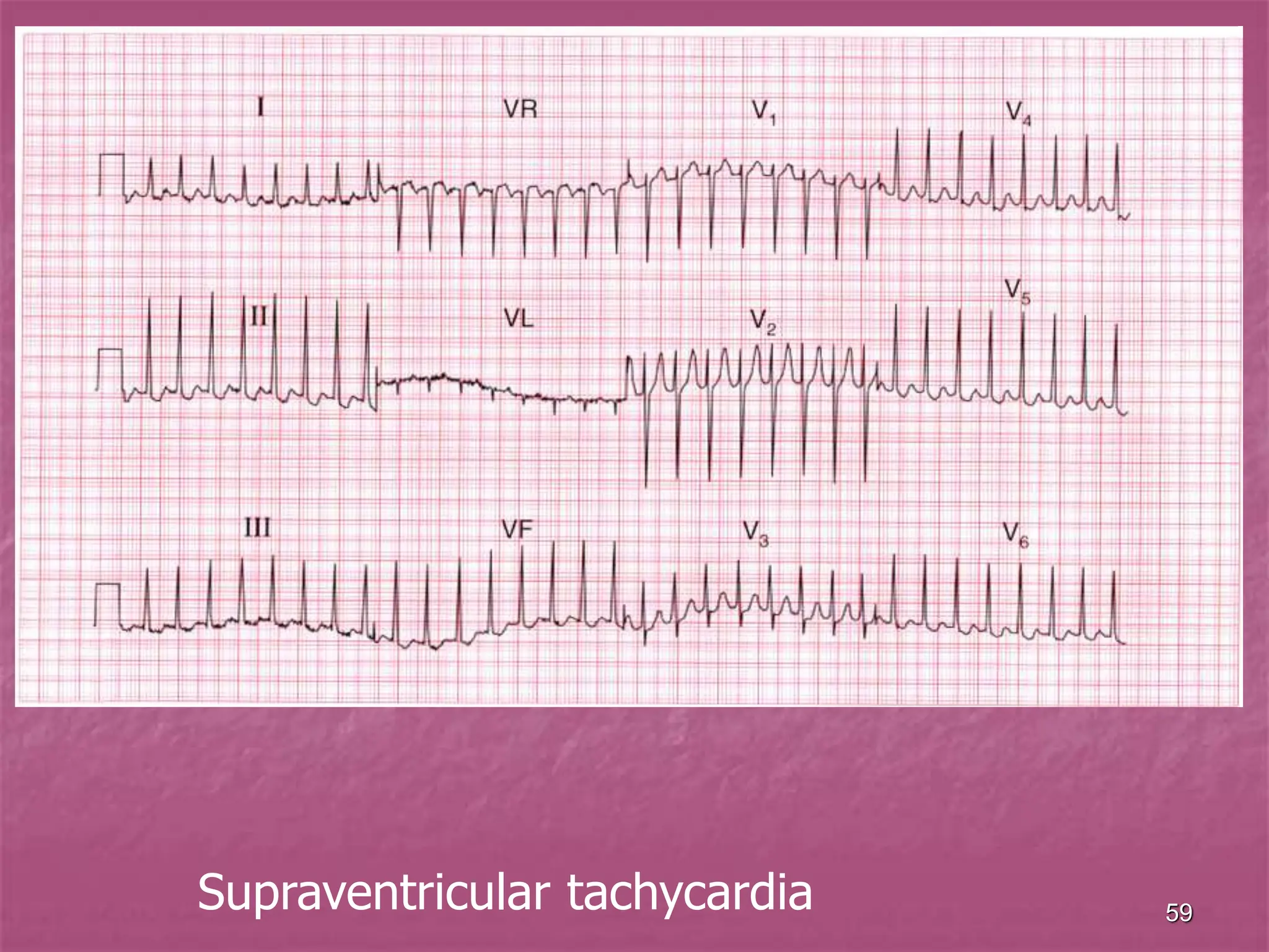 59
Supraventricular tachycardia
 