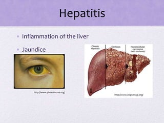 http://www.hopkins-gi.org/
http://www.phoenixcme.org/
Hepatitis
• Inflammation of the liver
• Jaundice
 
