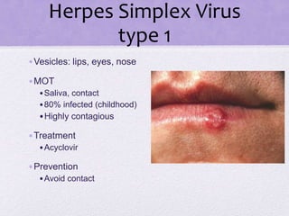 Herpes Simplex Virus
type 1
•Vesicles: lips, eyes, nose
•MOT
•Saliva, contact
•80% infected (childhood)
•Highly contagious
•Treatment
•Acyclovir
•Prevention
•Avoid contact
 