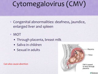Cytomegalovirus (CMV)
• Congenital abnormalities: deafness, jaundice,
enlarged liver and spleen
• MOT
• Through placenta, breast milk
• Saliva in children
• Sexual in adults
Can also cause abortion
 