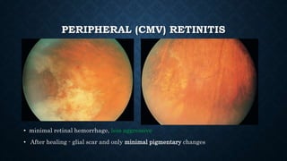 PERIPHERAL (CMV) RETINITIS
• minimal retinal hemorrhage, less aggressive
• After healing - glial scar and only minimal pigmentary changes
 