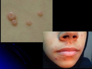 Common Viral Skin Diseases