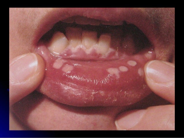 herpetic rash #10