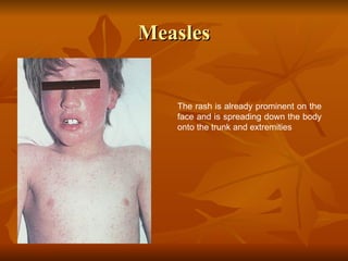 Measules Rash Trunk Viral skin infection | PPT