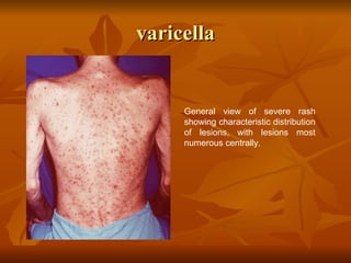 Variecella Rash Viral skin infection | PPT