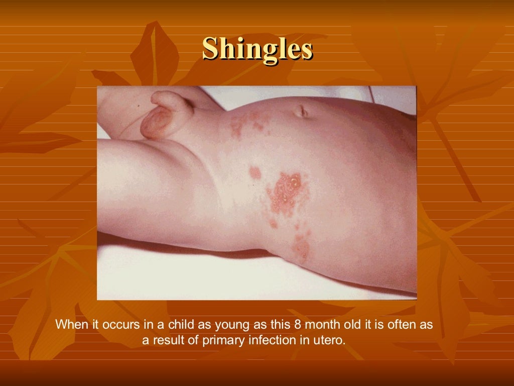 Viral Skin Infection