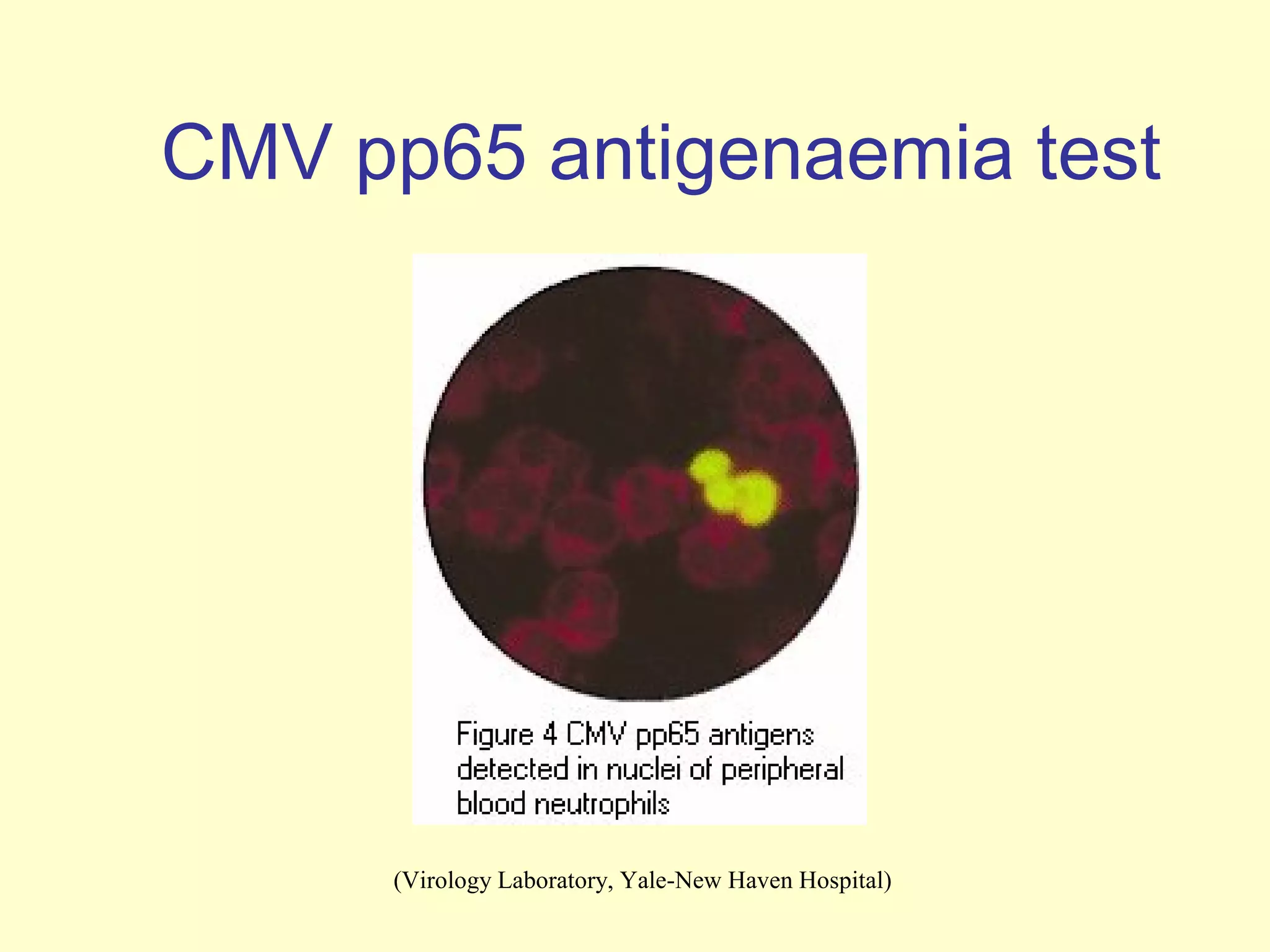 CMV pp65 antigenaemia test




      (Virology Laboratory, Yale-New Haven Hospital)
 