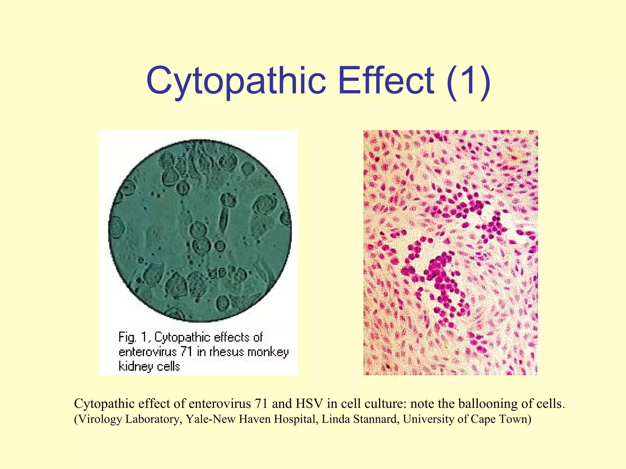 Cytopathic Effect (1)




Cytopathic effect of enterovirus 71 and HSV in cell culture: note the ballooning of cells .
(Virology Laboratory, Yale-New Haven Hospital, Linda Stannard, University of Cape Town)
 
