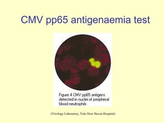 CMV pp65 antigenaemia test




      (Virology Laboratory, Yale-New Haven Hospital)
 