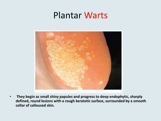 Plantar Warts
• They begin as small shiny papules and progress to deep endophytic, sharply
defined, round lesions with a rough keratotic surface, surrounded by a smooth
collar of calloused skin.
 