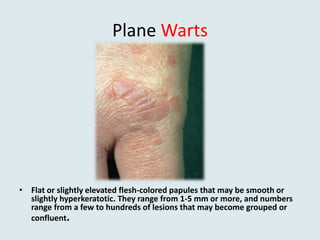 Plane Warts
• Flat or slightly elevated flesh-colored papules that may be smooth or
slightly hyperkeratotic. They range from 1-5 mm or more, and numbers
range from a few to hundreds of lesions that may become grouped or
confluent.
 