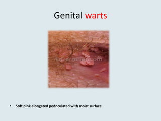 Genital warts
• Soft pink elongated pednculated with moist surface
 