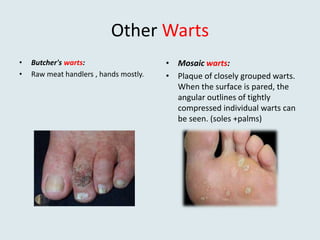 Other Warts
• Butcher's warts:
• Raw meat handlers , hands mostly.
• Mosaic warts:
• Plaque of closely grouped warts.
When the surface is pared, the
angular outlines of tightly
compressed individual warts can
be seen. (soles +palms)
 