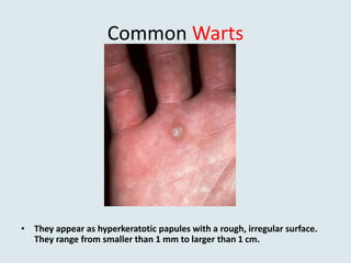 Common Warts
• They appear as hyperkeratotic papules with a rough, irregular surface.
They range from smaller than 1 mm to larger than 1 cm.
 