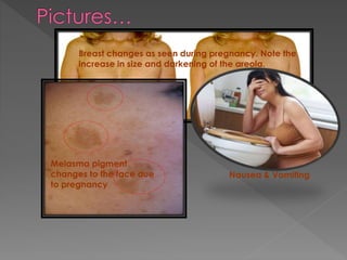 Breast changes as seen during pregnancy. Note the
increase in size and darkening of the areola.
Melasma pigment
changes to the face due
to pregnancy
Nausea & Vomiting
 