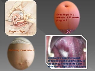 Fluttering movements!
Hegar’s Sign
Linea Nigra in a
woman at 22 weeks
pregnant.
Chadwick’s Sign- Increased
circulation to the vagina early in
pregnancy changes the color
from normal light pink to a purple
 