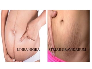 LINEA NIGRA STRIAE GRAVIDARUM
 