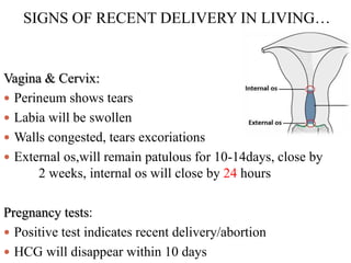 SIGNS OF RECENT DELIVERY IN LIVING…
Vagina & Cervix:
 Perineum shows tears
 Labia will be swollen
 Walls congested, tears excoriations
 External os,will remain patulous for 10-14days, close by
2 weeks, internal os will close by 24 hours
Pregnancy tests:
 Positive test indicates recent delivery/abortion
 HCG will disappear within 10 days
 