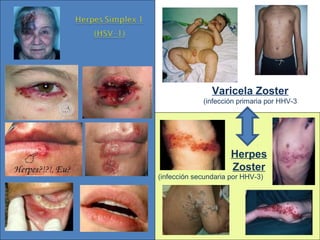 (infección secundaria por HHV-3)
Herpes
Zoster
Varicela Zoster
(infección primaria por HHV-3
 