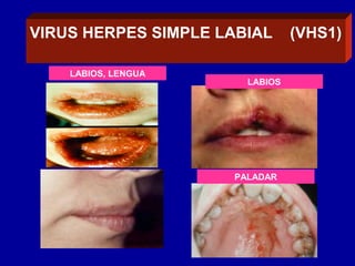 VIRUS DEL HERPES LABIALVIRUS HERPES SIMPLE LABIAL (VHS1)
LABIOS
LABIOS, LENGUA
PALADAR
 