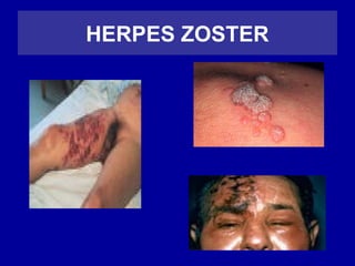 HERPES ZOSTER
 