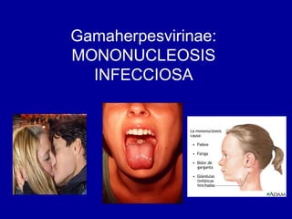 Gamaherpesvirinae:
MONONUCLEOSIS
INFECCIOSA
 