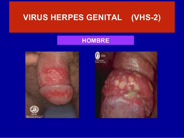 Si es posible es el rábano a la psoriasis