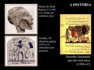 A HISTÓRIA
Desenho ilustrando
um cão com raiva
(1500 a.C)
Múmia do faraó
Ramsés V (1196
a.C): lesões de
varíola na face
Entalhe, 18ª
dinastria egípcia
(370 a.C):
indivíduo com
paralisia
 